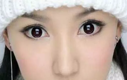 什么是韓式雙眼皮手術